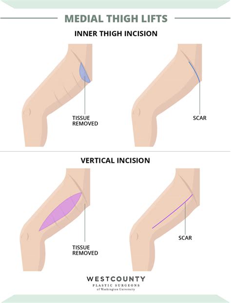 The Different Types Of Thigh Lift Procedures Compared